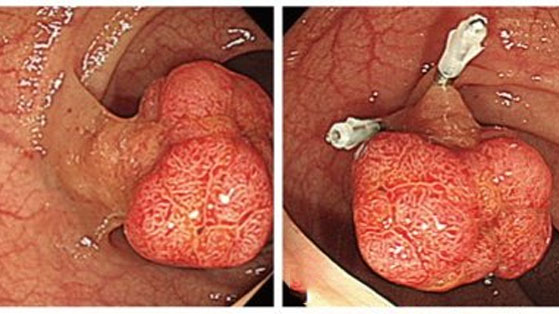Endoscopic Polypectomy